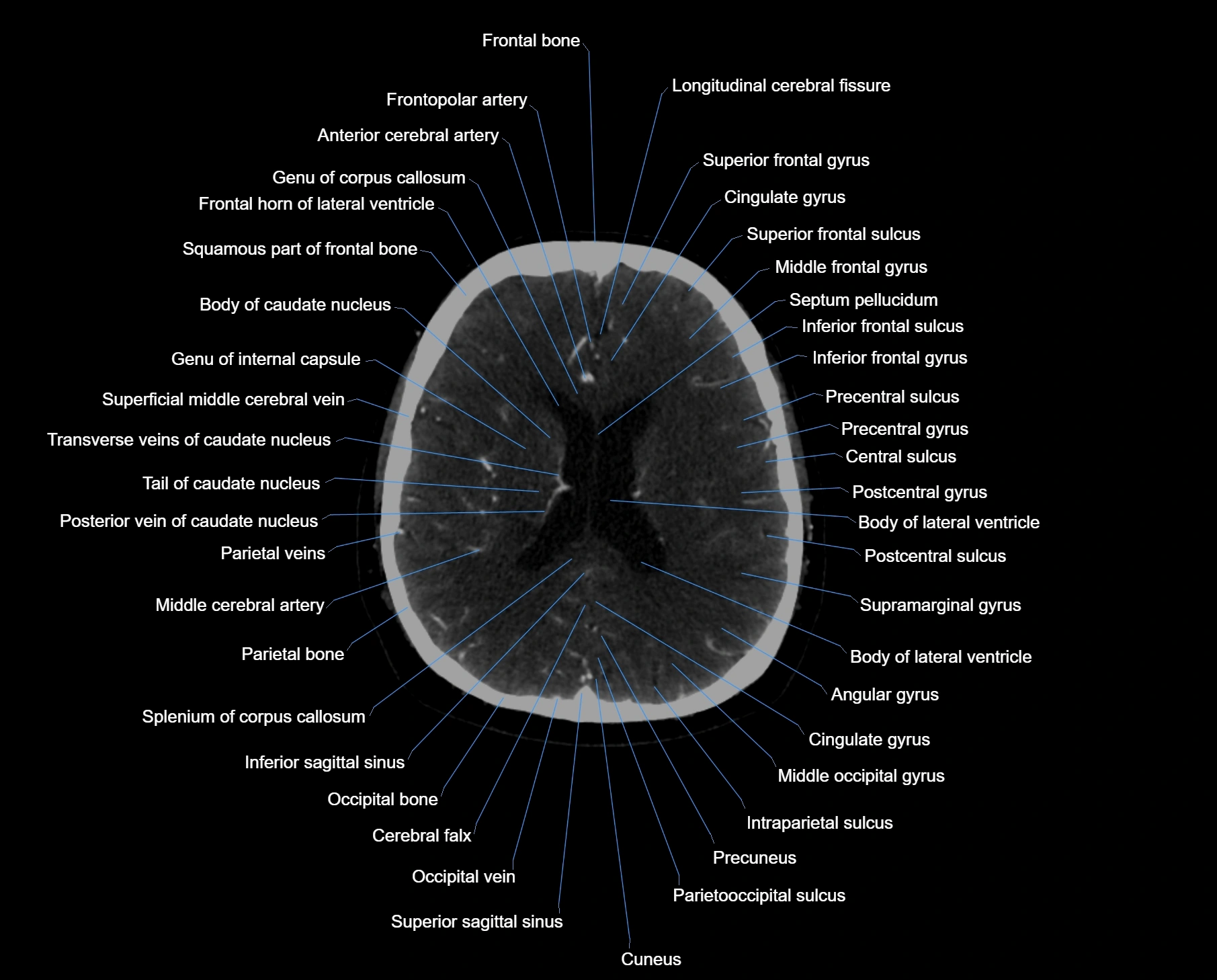 CT scan brain axial labelled cross sectional anatomy image-img-000044.webp